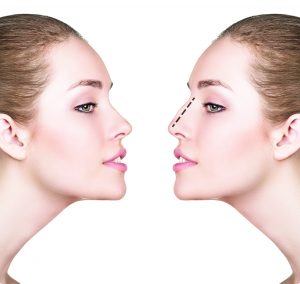 Female face, before and after cosmetic nose surgery isolated on white