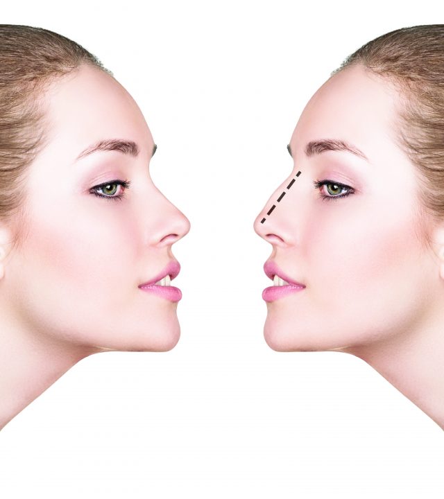 Woman before and after cosmetic nose surgery