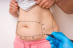 74104446 - plastic surgery doctor draw lines with black marker on patient belly