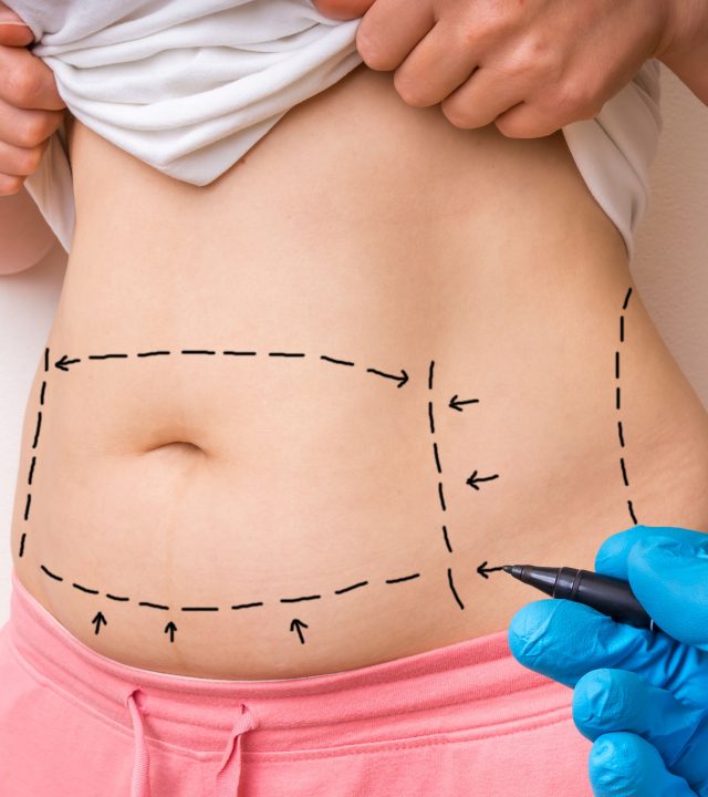 74104446 – plastic surgery doctor draw lines with black marker on patient belly